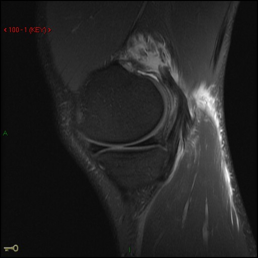 Figure 2 for case Medial head of gastrocnemius muscle ( RID2921 ) avulsion